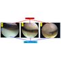 JPEG　20220618 ブログ用　Cartilage injury.jpg