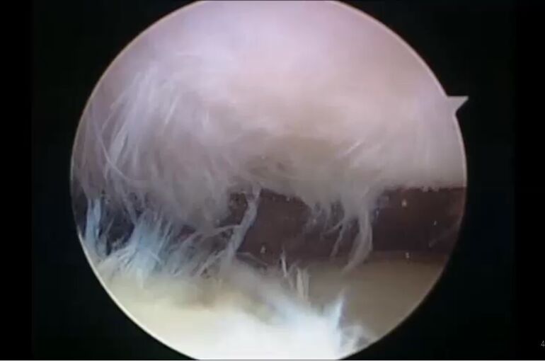 JPEG Synovitis