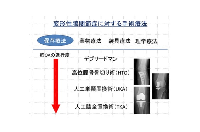 変形性膝関節症に対する手術療法
