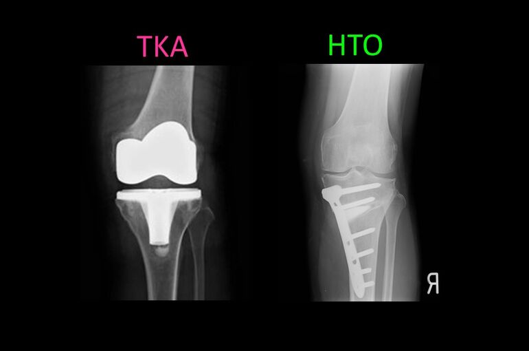 左はTKA、右はHTOのレントゲン画像