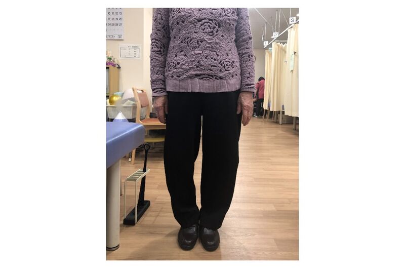 O脚　施術前