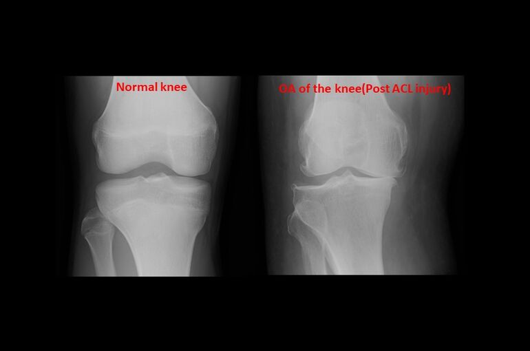 ACL損傷を放置して数年経った方のレントゲン写真