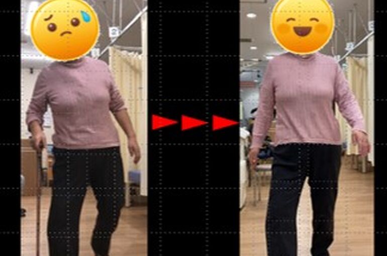 施術前後の写真　逸脱した半月板に対する徒手療法