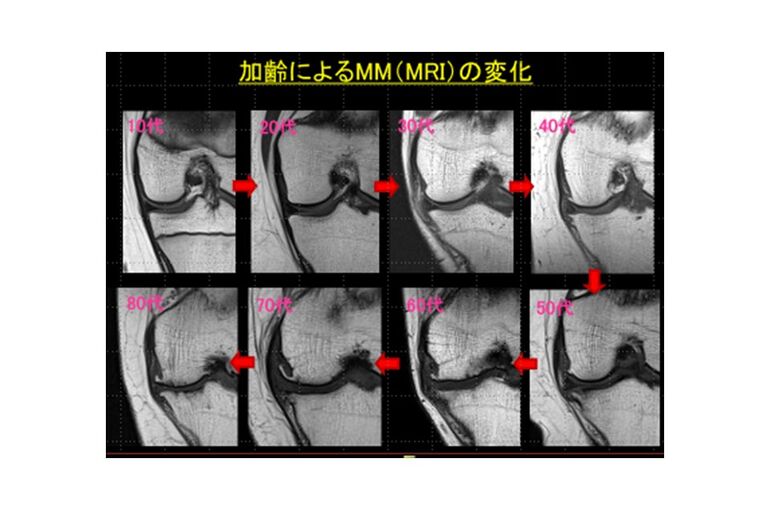 【年代別　膝　MRI　T1強調画像】
