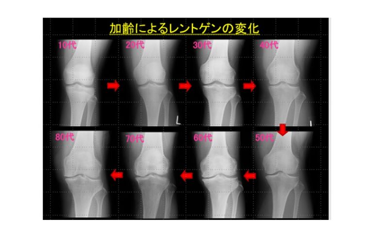 年代別　膝のレントゲン